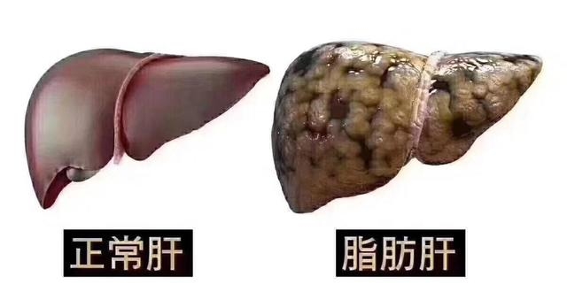 许幻山因脂肪肝断食晚餐 脂肪肝到底有多可怕 腾讯网