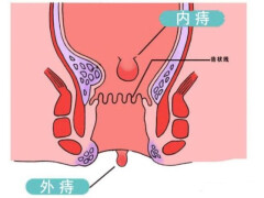 被痔疮屁股坐过的椅子能坐吗?