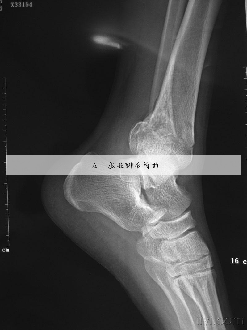 球员腓骨骨折