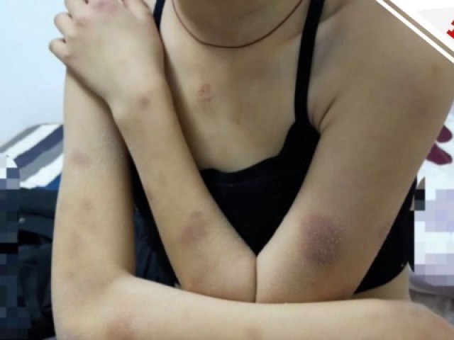 河北邢台初一女生被7名同学殴打遍体鳞伤 母亲都没认出来