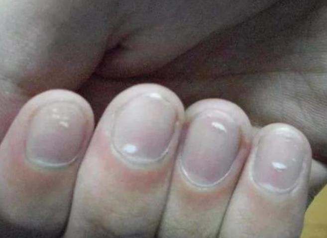 手指甲出现这种"白点",说明是肝病的信号,大家别忽视!