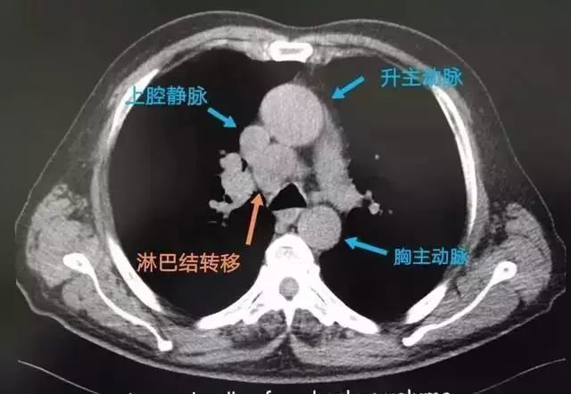 检查结果出来后让他大吃一惊,右肺背侧靠近胸膜的位置, 长了一个小