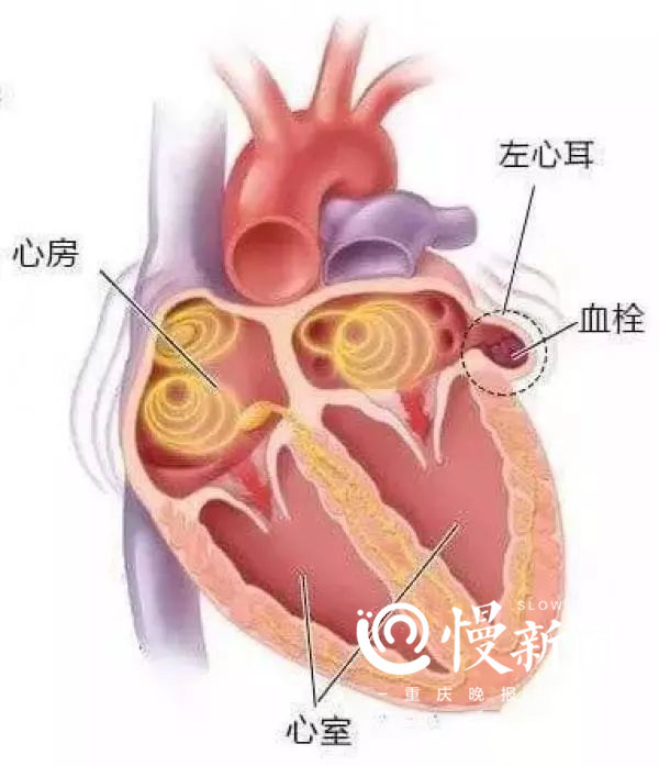 左心耳封堵术为心脏撑起一把"伞"