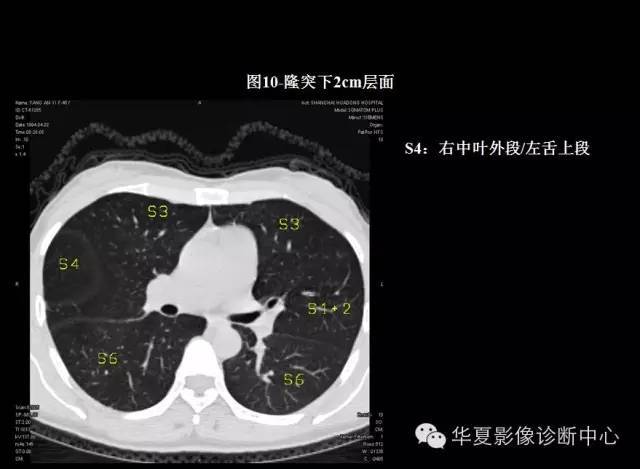 肺段ct的解剖,这下终于搞清楚了!