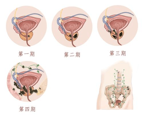 前列腺癌的症状通常包括