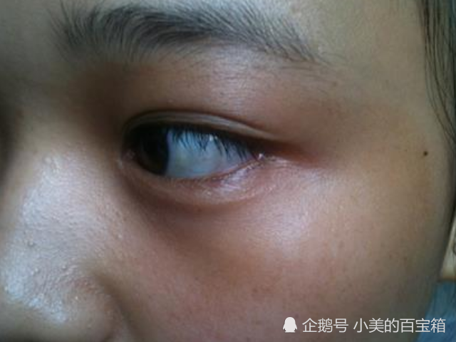 眼睛,眼睛发黄