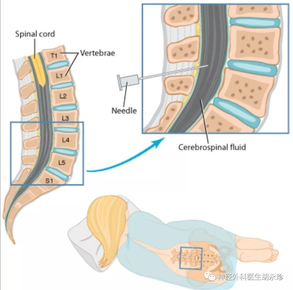 腰椎穿刺术,我们为什么要做?