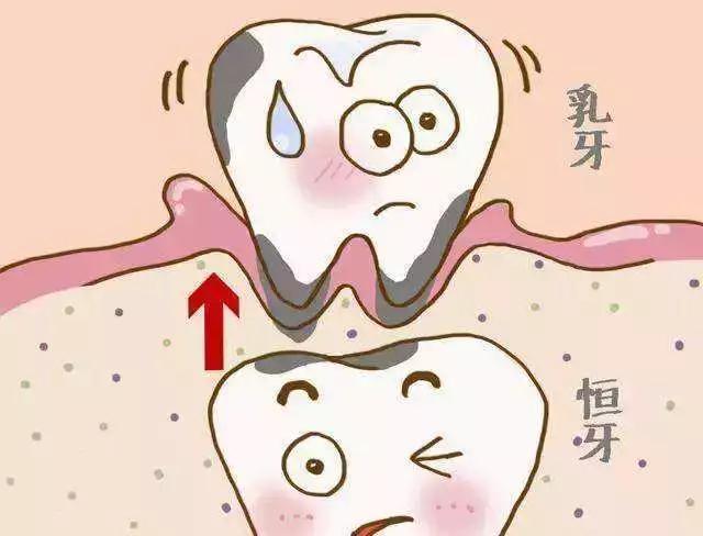 乳牙虽然最终要替换,但乳牙的功能如咀嚼,发音和美观都会因为龋齿而