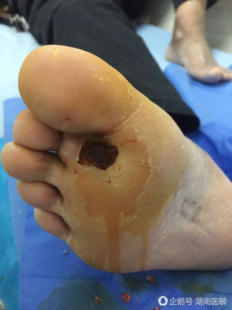 益阳一男子脚被钉子扎 致足底溃疡、发烧畏冷