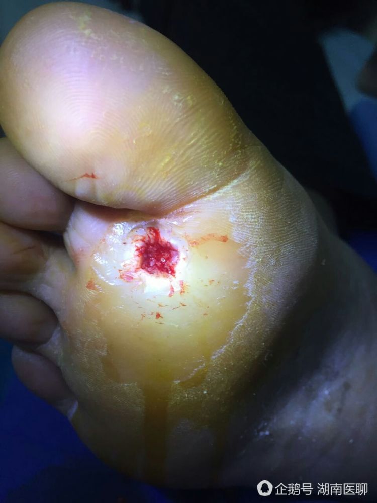 益阳一男子脚被钉子扎 致足底溃疡、发烧畏冷