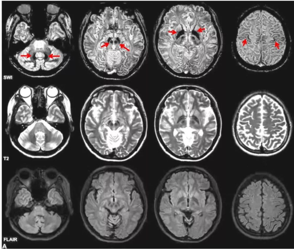 直径 图:双侧齿状核,黑质,苍白球,及皮层对称性异常信号;swi,t2,flair