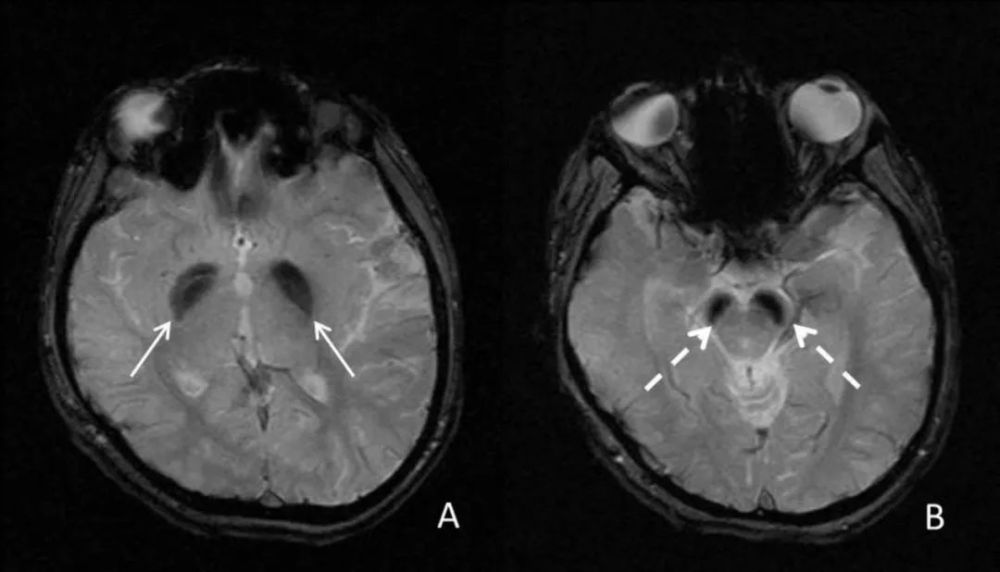 直径 图:双侧齿状核,黑质,苍白球,及皮层对称性异常信号;swi,t2,flair
