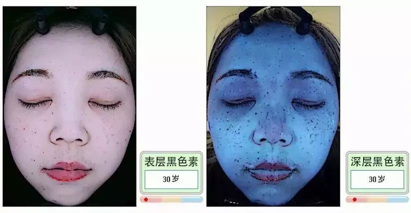 10年黑色素在肌肤底层狂欢作妖,难怪黑皮难退,百"斑"刁难