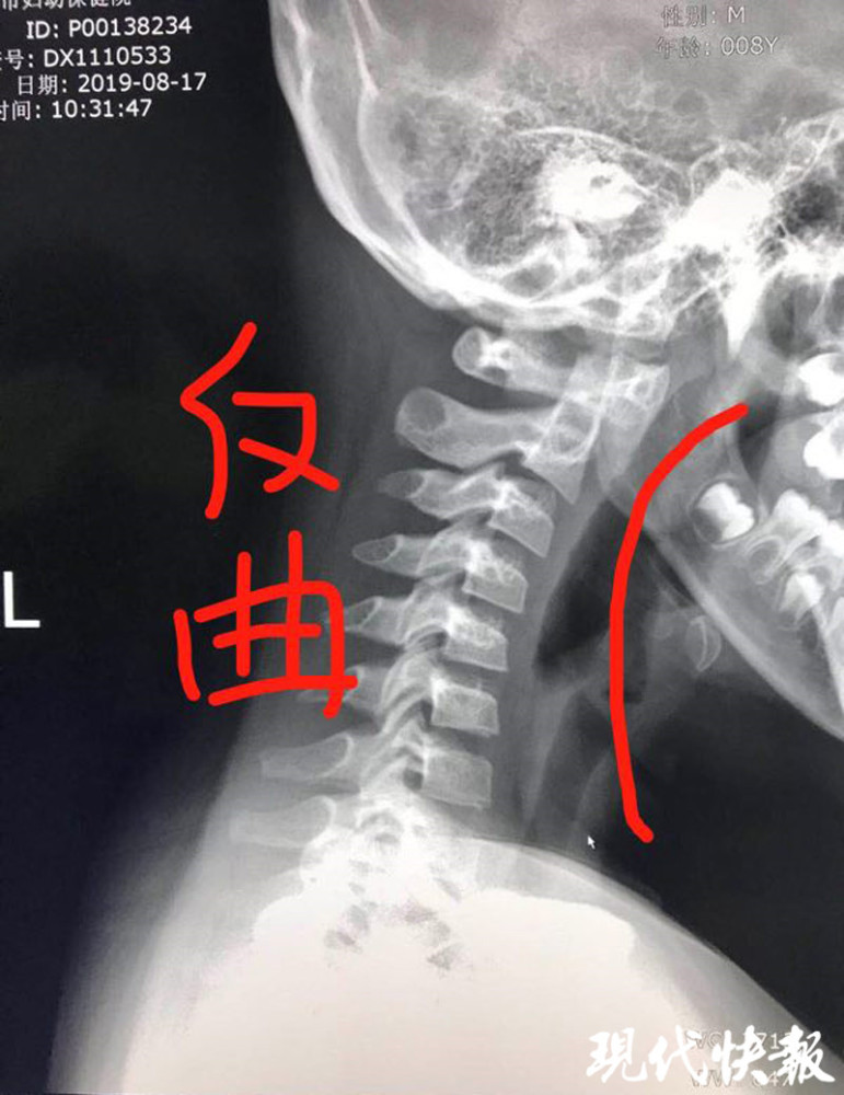 每天玩五六个小时电子产品,8岁男孩患上颈椎病