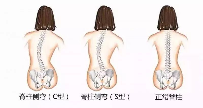 但是如果脊柱侧弯了 那健身时要注意什么呢 首先,也是最重要的一点