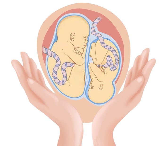 双胞胎共享胎盘 一个突然胎死腹中