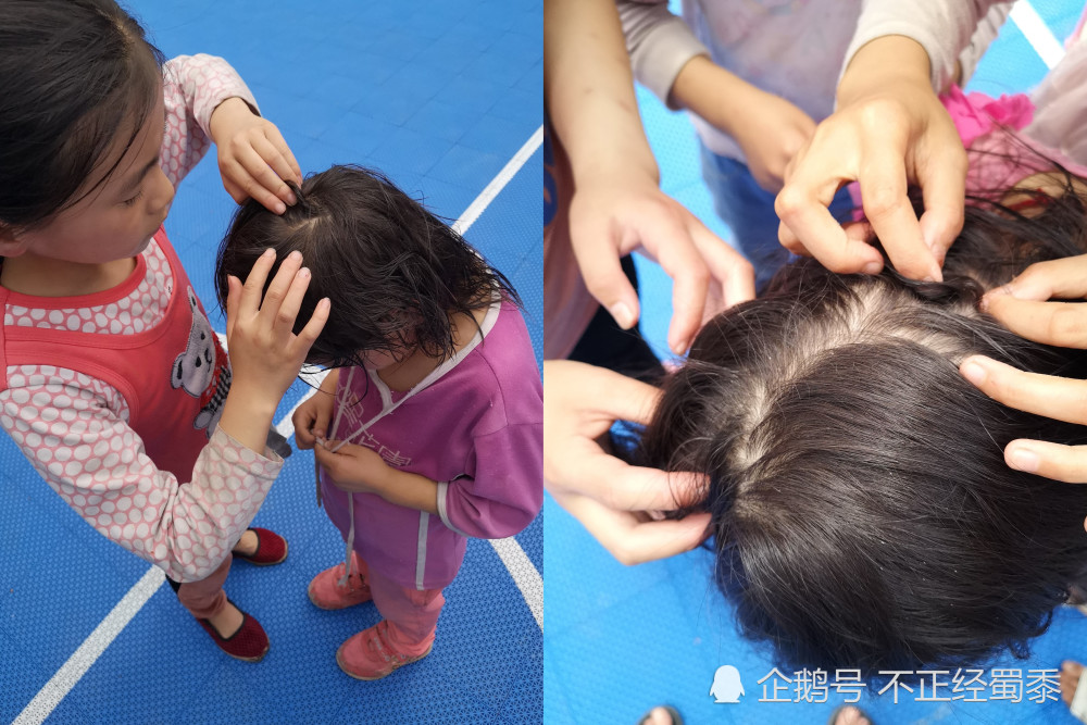 9岁蓝眼睛女孩头上虱子如珠串,姐弟3人被傻娘饿的哇哇