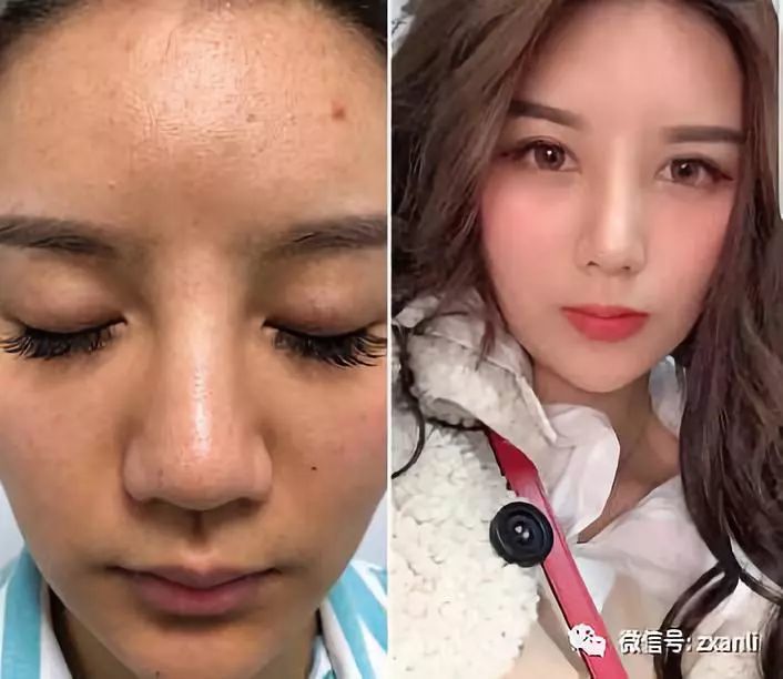 玻尿酸注射太多导致鼻梁变宽,一气之下做了鼻综合,比预期恢复得要快