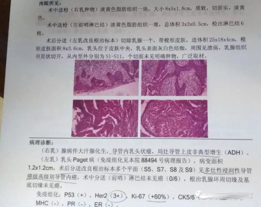 1874年paget报道了15例乳头乳晕湿疹样改变病例,均伴有同侧乳腺癌,故