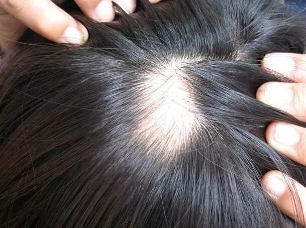 看着渐渐"消失"的头发,斑秃离你还远吗?