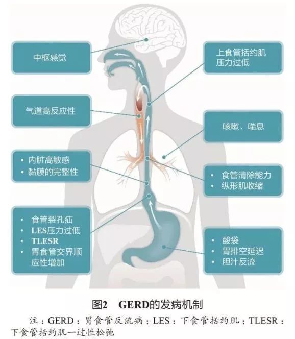 4 发病机制 gej由多个结构构成其抗反流功能:下食管括约肌(lower