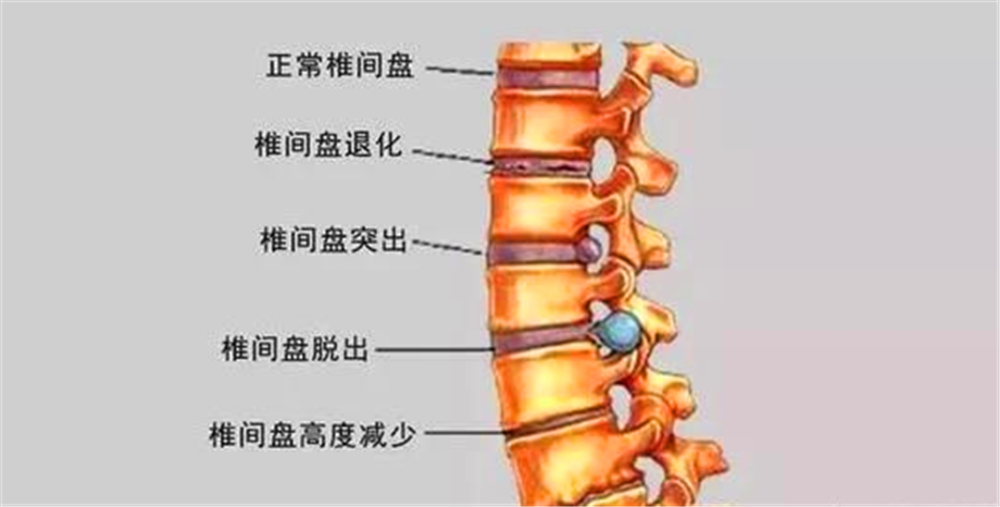 腰椎间盘突出,压迫坐骨神经痛,该怎么办?