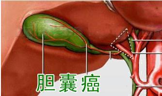 特殊时期,胆结石患者一定要记住的3个胆结石疼痛应急方法