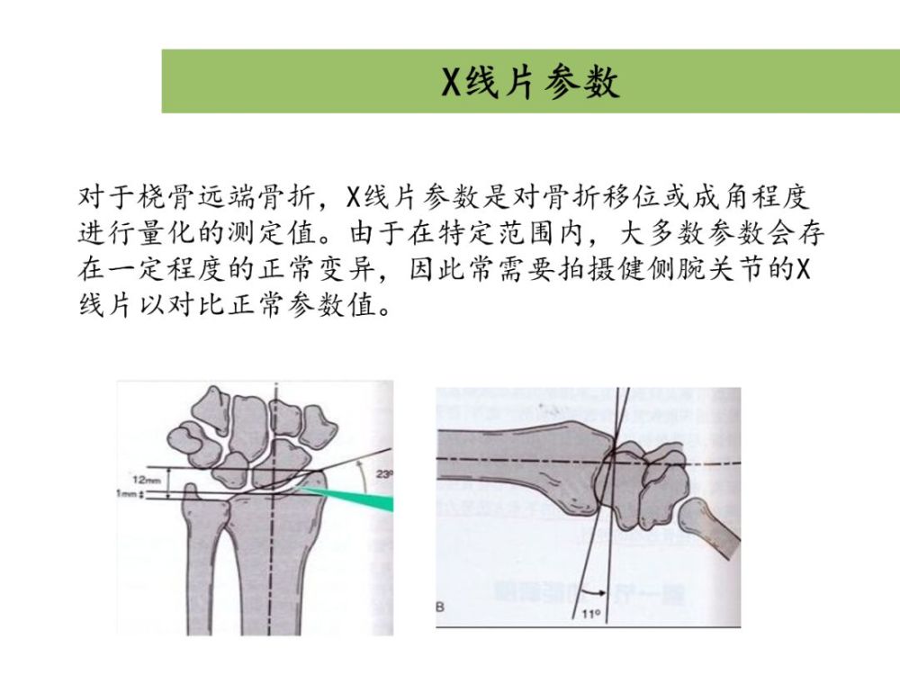 桡骨远端骨折