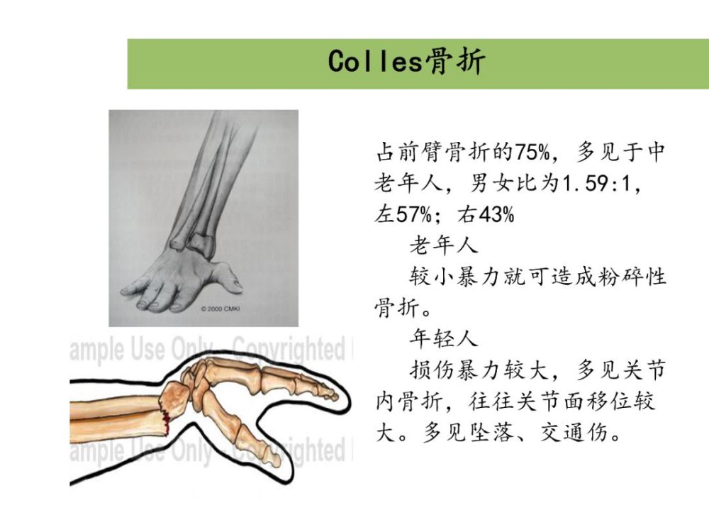 桡骨远端骨折