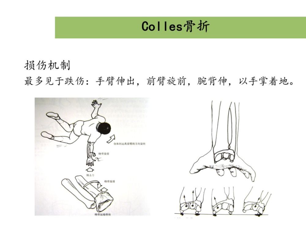 桡骨远端骨折