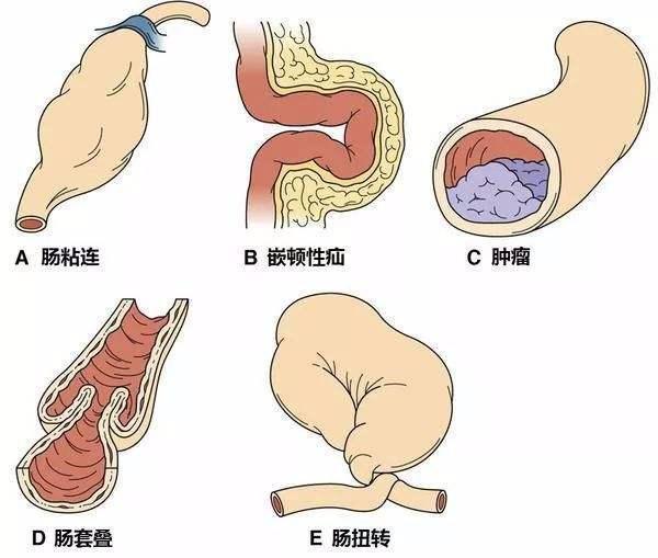 肠梗阻治疗不及时会致命,医生提醒:出现这4个症状,请马上就医