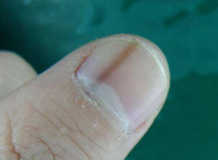 手指甲出现"黑线",到底是怎么回事?医生:警惕黑色素瘤
