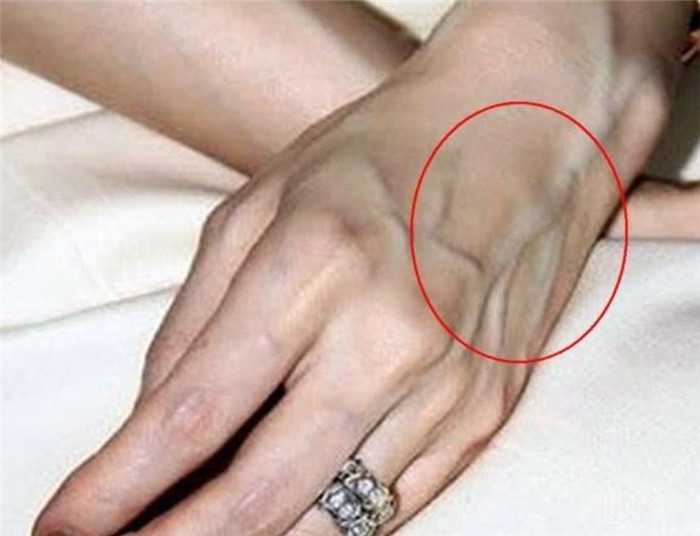 为什么有人手的上青筋凸起明显?青筋多是身体差的表现