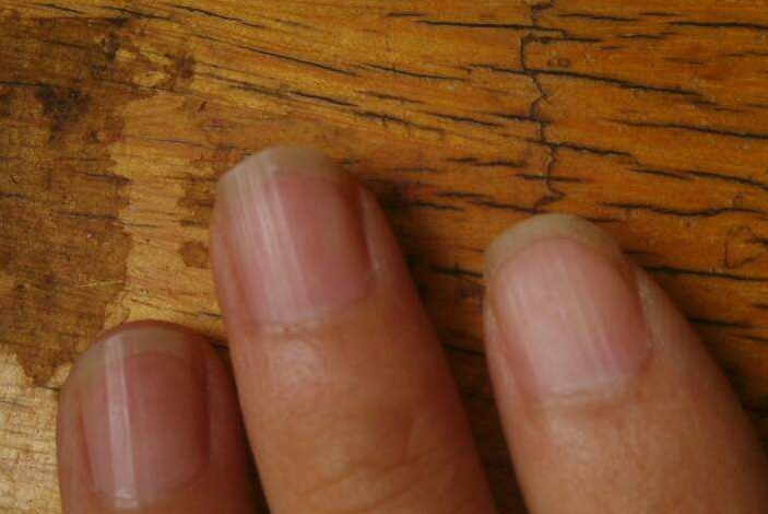 手指甲上长满"竖纹",多半是身体正遭受"3病症",早知早