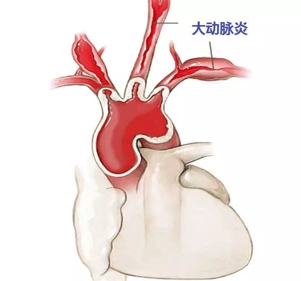 本病多见于主动脉弓及其分支(图15),其次为降主动脉,腹主动脉和肾动脉