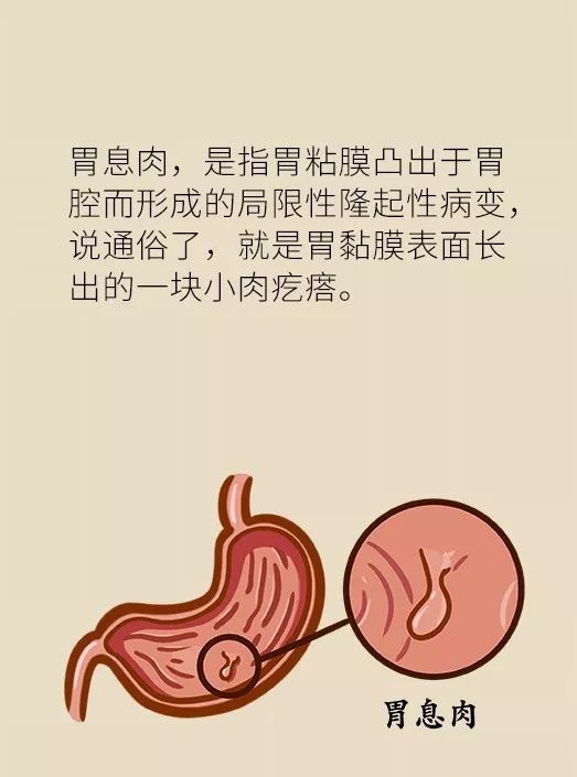 胃息肉是不是胃癌先兆?应不应该切?这些知识你必须知道