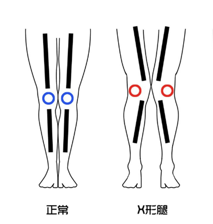 膝关节,肌肉,髂胫束,大腿,x型腿