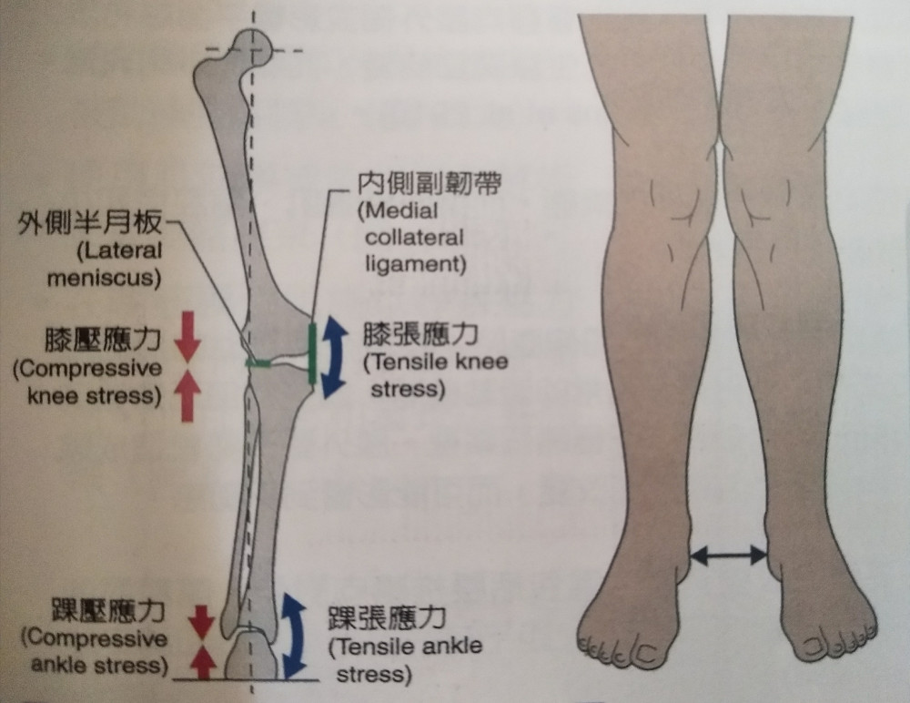 膝关节,肌肉,髂胫束,大腿,x型腿