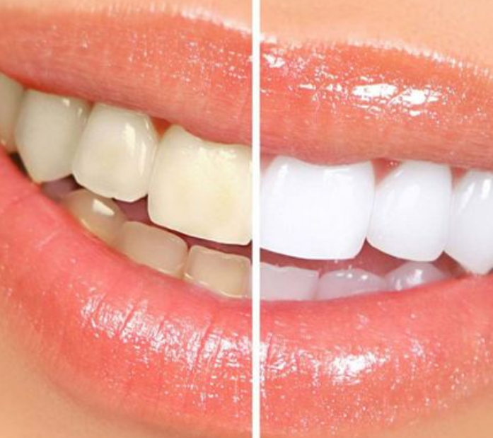 正常情况下牙齿的颜色是白色的,但是有些人平时不注意牙齿的健康