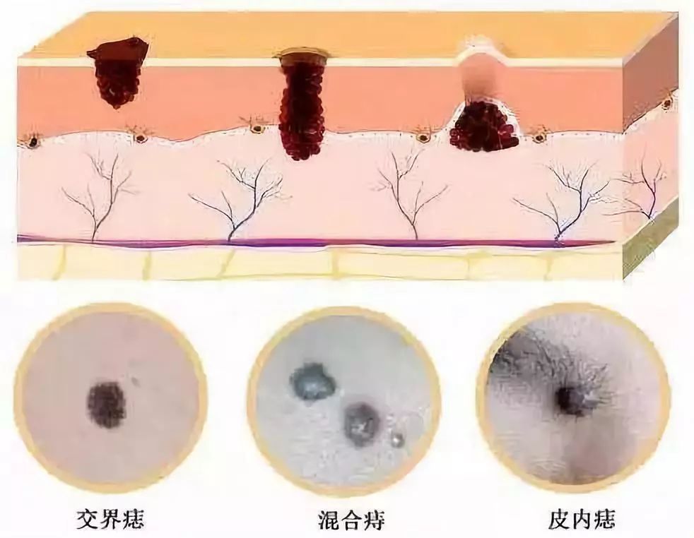 痣可以随便点吗?它除了影响美观,竟然还有这些潜在威胁!