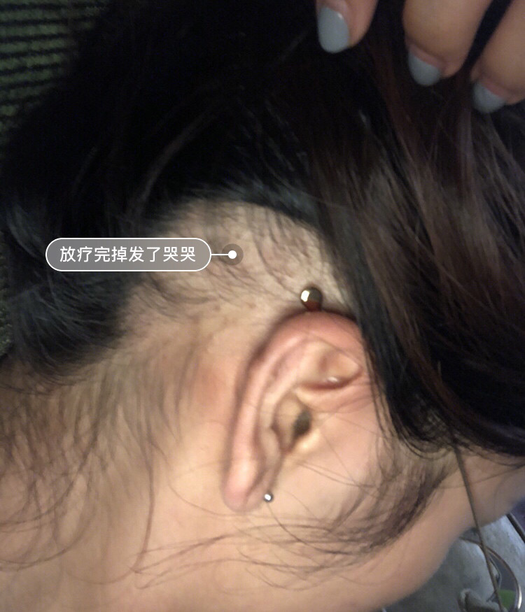 女生千万不要轻易尝试打耳洞,如果出现疤痕增生,后悔都晚了!