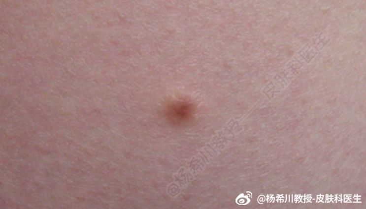杨教授每周病例分享:皮肤纤维瘤