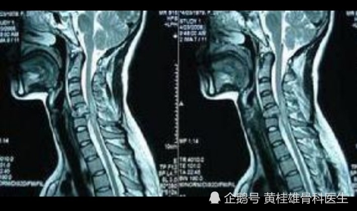 脊髓损伤是脊柱外科最常见的疾病,一般患者都会有外伤史.