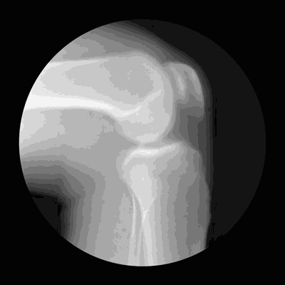 关节腔等组成 关节腔里充满滑液 让膝盖能够平滑地转动 位于大腿骨和