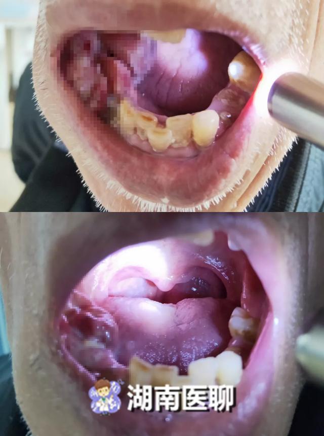 舌头几乎无法运动,不手术就能