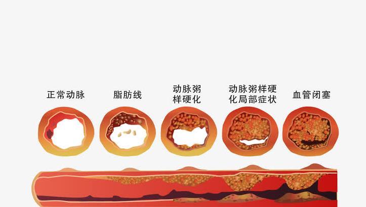 年轻人也开始"加盟"心肌梗死的真容了?是什么原因导致