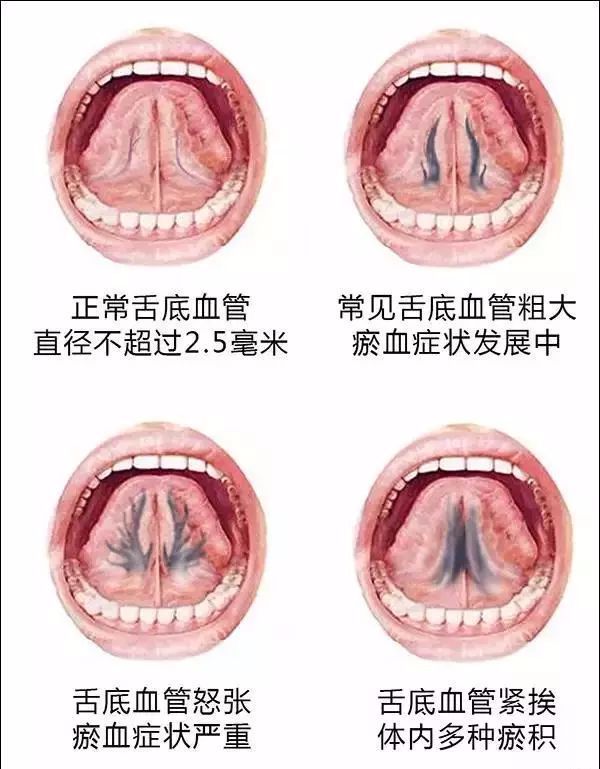 但是健康状态下,舌底静脉不会有明显突出,颜色也比较淡.