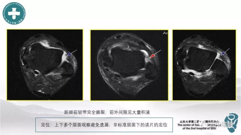 踝关节周围韧带的mri解读