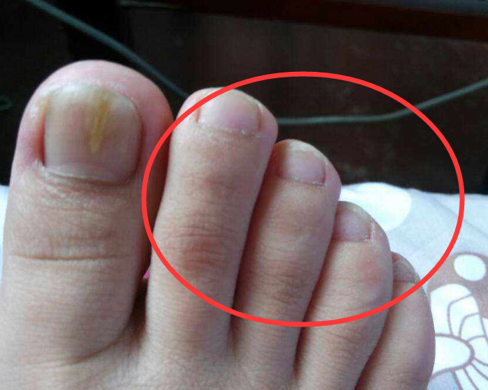 脚趾甲长进肉里怎么办?注意这3点,不用去医院就能治好