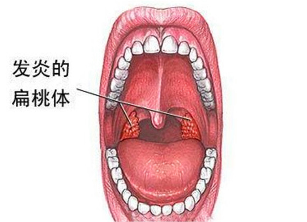 扁桃体经常发炎,可以切除扁桃体吗,对身体有什么影响吗?